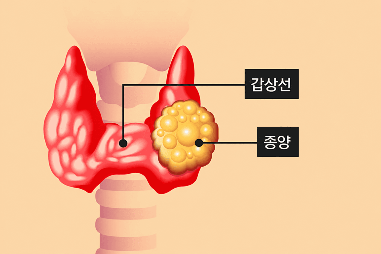 초음파 검사를 통해 갑상선 종양의 크기와 위치를 확인합니다.