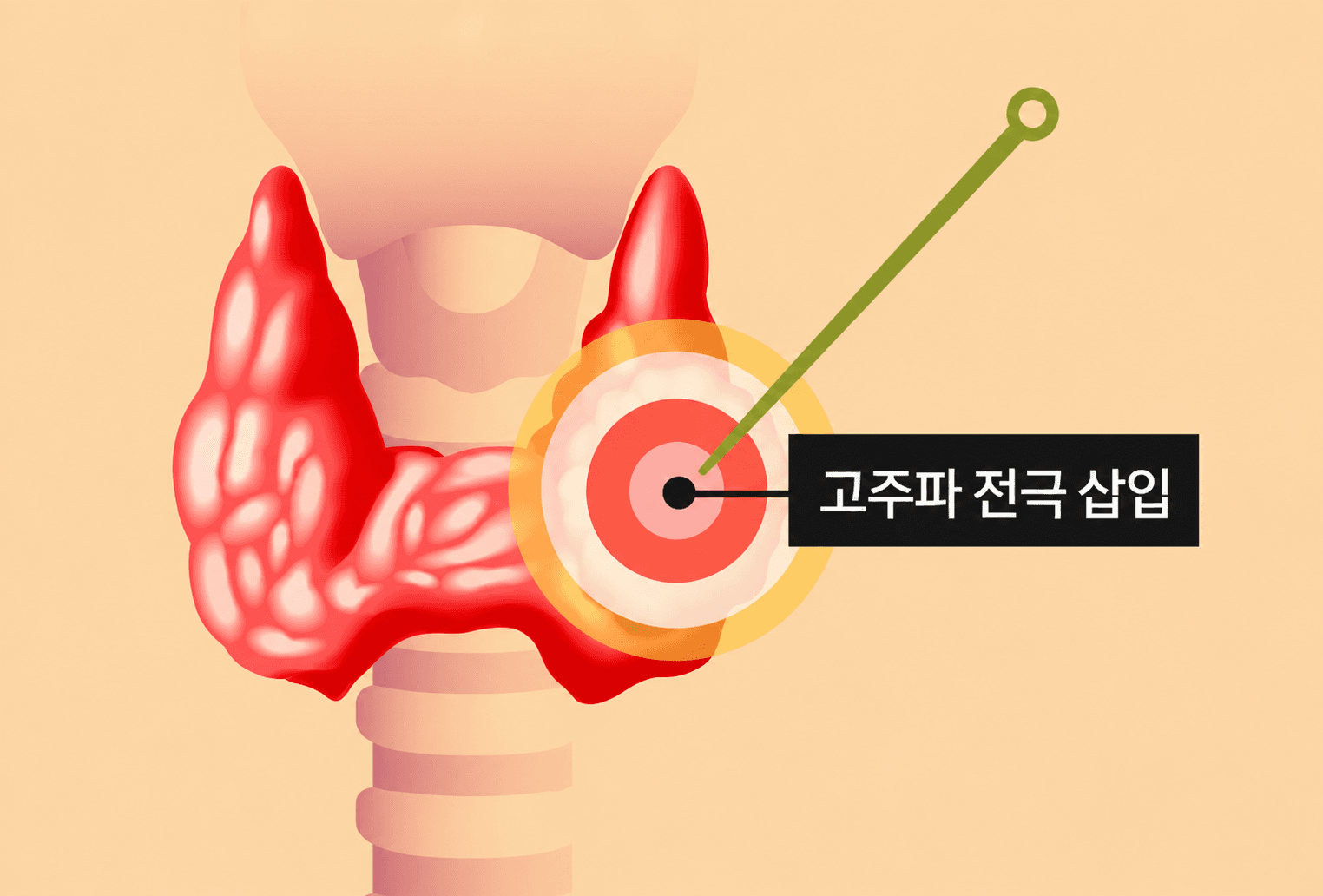 초음파를 통해 종양을 실시간으로 관찰하면서 1MM 굵기의 가는 바늘로 고주파 열을 삽입하여 종양을 구석구석 괴사시킵니다.