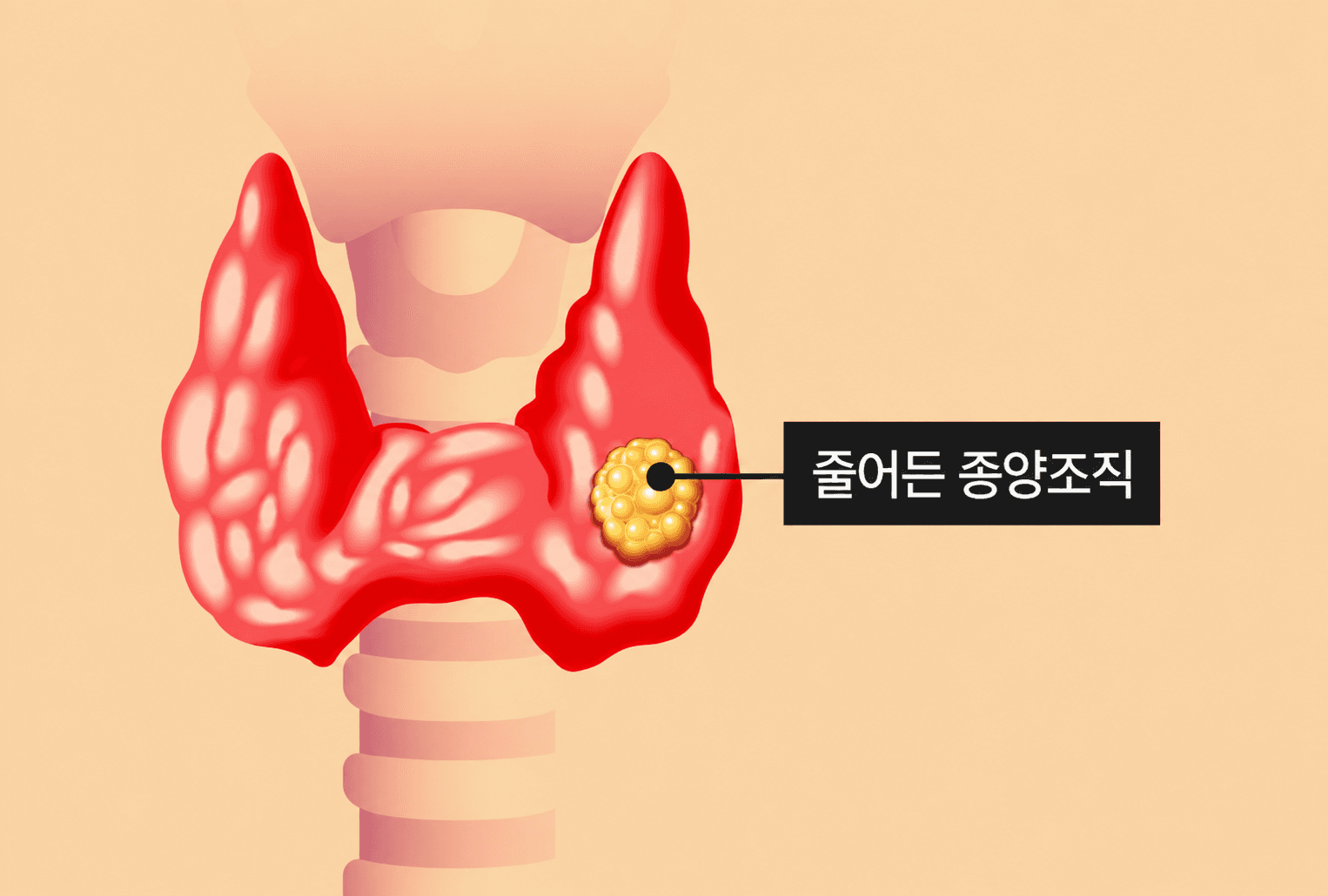 괴사된 종양의 크기가 작아지면서 그에 따른 증상도 함께 사라지게 됩니다.