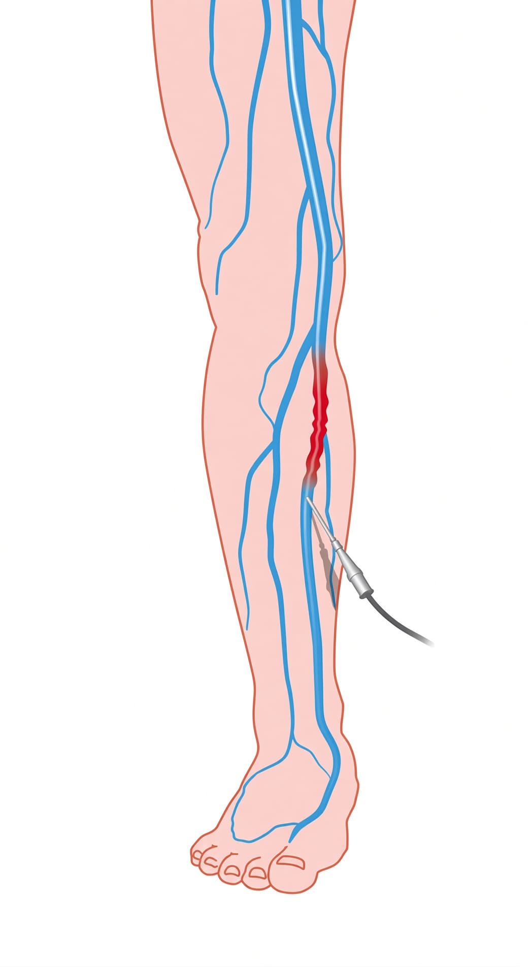 하지정맥류 혈관에 레이저 관을 삽입하는 위치