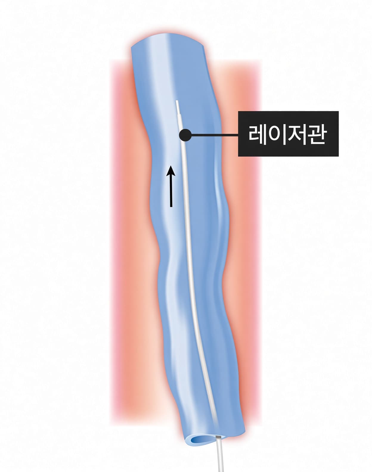 주사 바늘을 통해 레이저 관을 다리 혈관 속으로 삽입합니다.