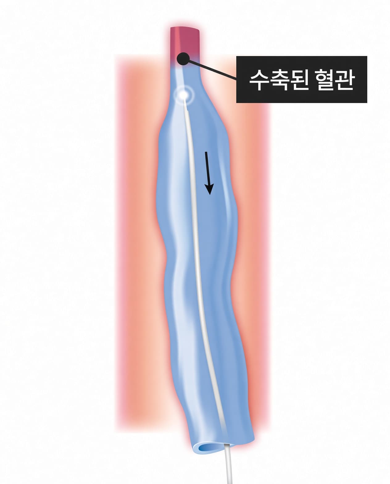 레이저 관을 통해 열을 주입하여 혈관을 급속히 수축시킵니다.