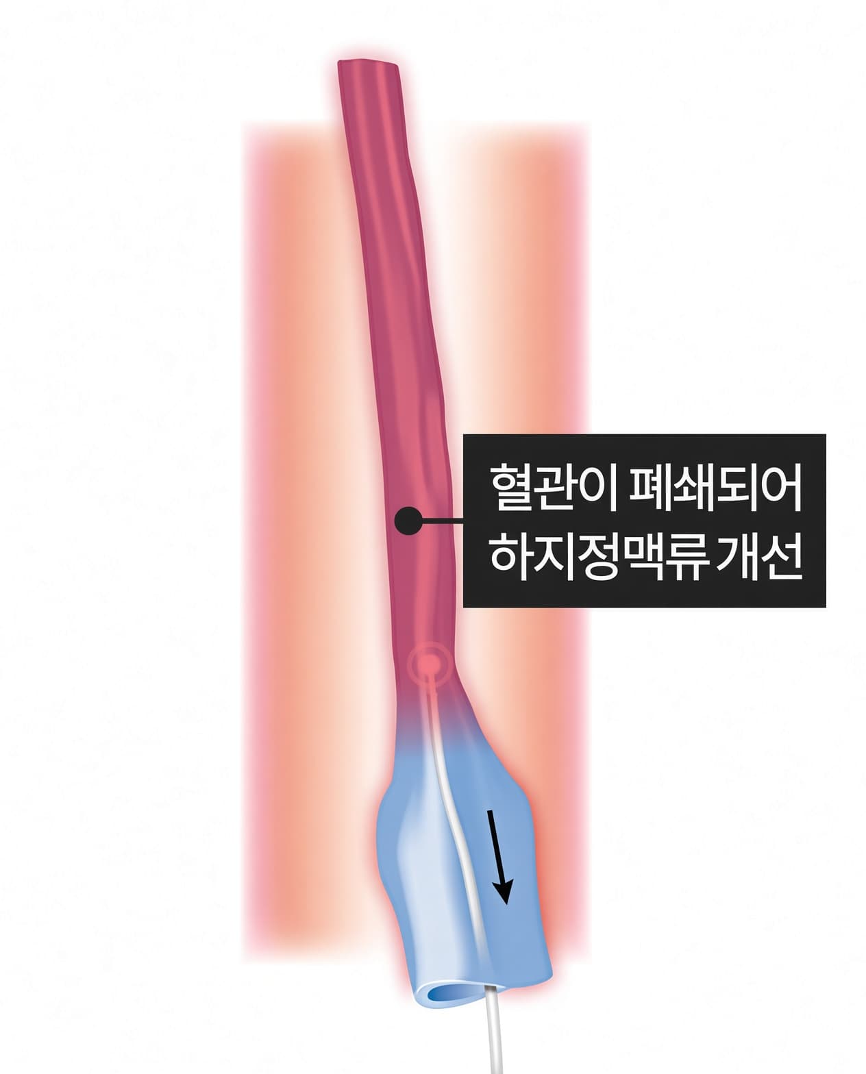 수축된 혈관으로 혈액의 유입이 이루어지지 않아 결국 혈관이 폐쇄되어 정맥류가 개선됩니다.