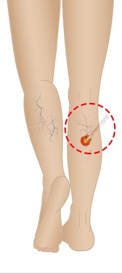 하지정맥류 혈관에 고주파 카테터를 삽입하는 위치